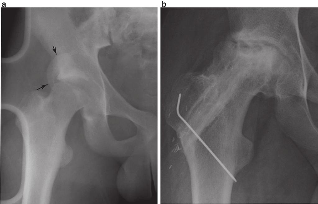 16 (a) AP radiograph of the pelvis in a 14-yearold male s/p MVA demonstrates traumatic epiphyseal separation of the right femoral head (black arrows) from the femoral neck, with posterior