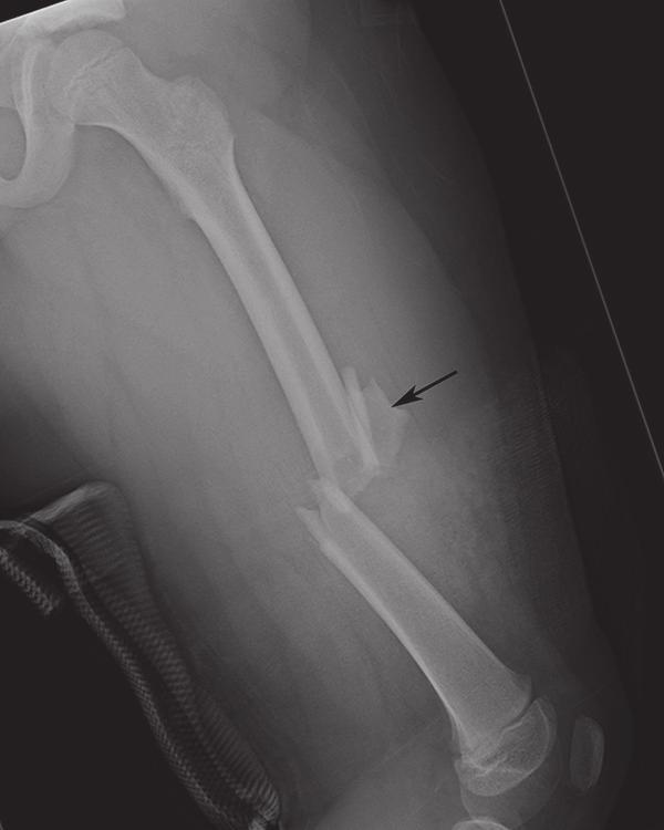 18 Lateral radiograph of the femur in a 6-year-old male s/p MVA demonstrates a comminuted fracture through the midshaft of the left femur with anterior angulation of the distal fracture fragment and