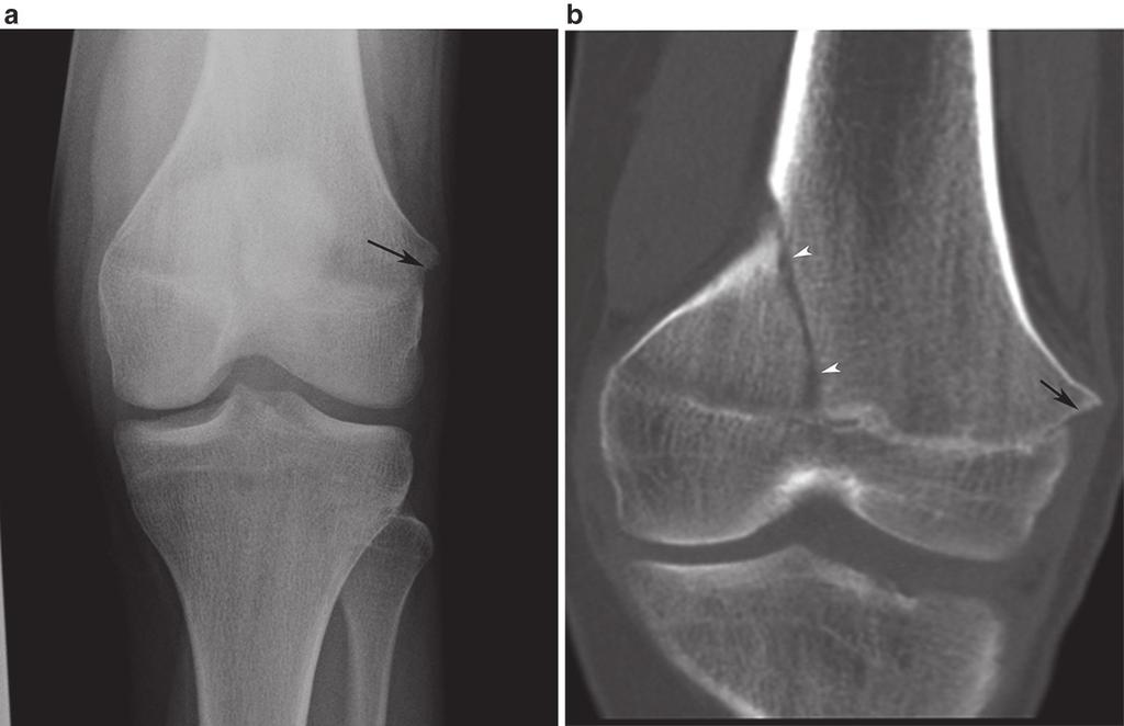 consistent with a Salter 2 fracture, (b) AP radiograph of the knee in a 15-year-old boy 2 weeks later demonstrates an obliquely oriented metaphyseal fracture (black arrows) with periosteal new bone