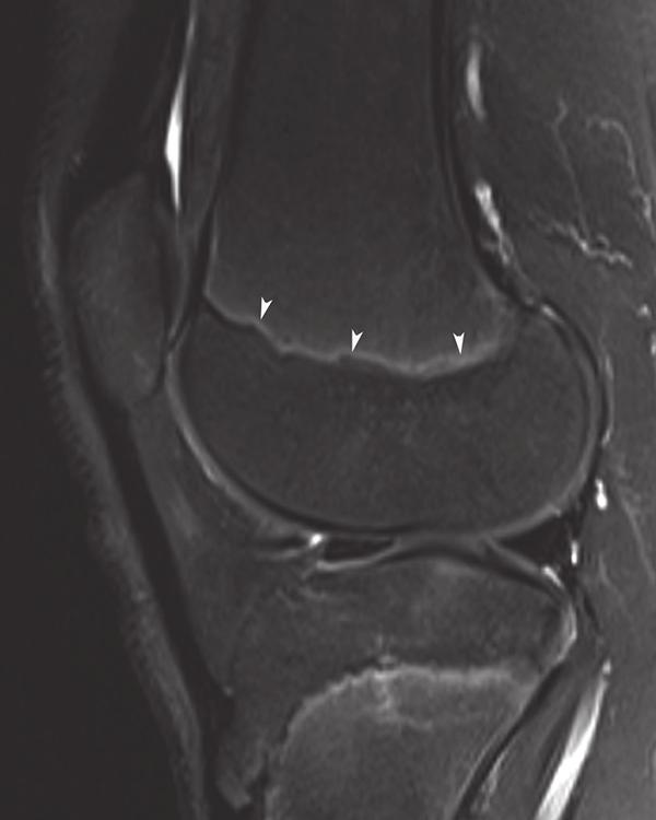 and abnormal fluid signal within a widened distal femoral physis (black arrow).
