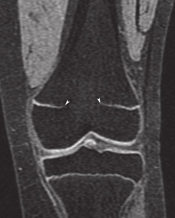 displacement of the femoral epiphysis with respect to the metaphysis (black arrows). There is also a moderate joint effusion Fig. 2.