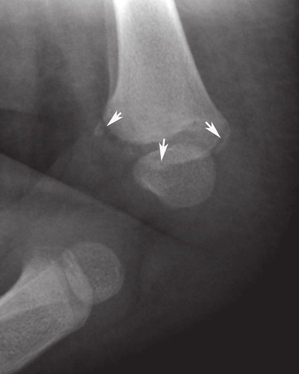 28 Coronal PD-weighted image with fat-suppression through the knee in a 16-year-old male with a Salter 2 fracture demonstrates a low-signal subarticular