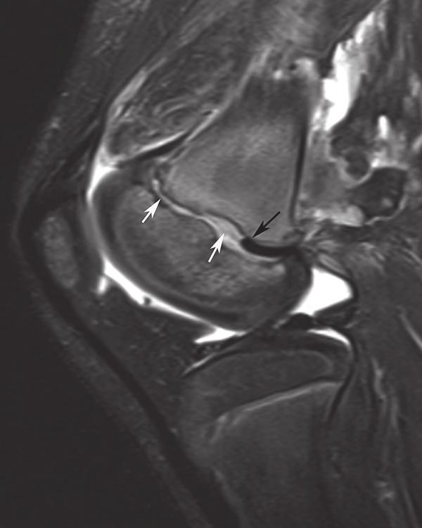 Incidental note is made of a NOF within the proximal tibia Fig. 2.