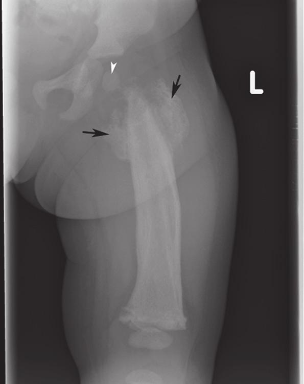 2 Radiologic Evaluation of Femur Fractures necrosis before irreversible damage has occurred.