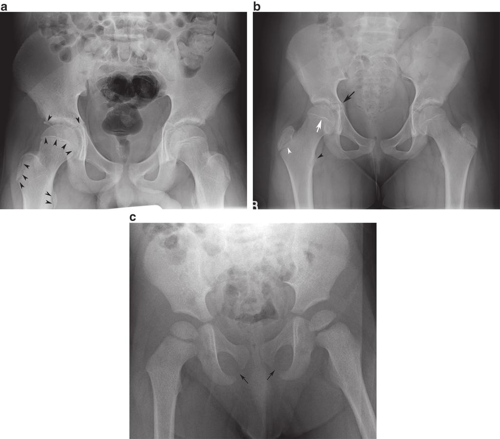 2 Radiologic Evaluation of Femur Fractures 31 ment, including the operative approach. Femoral head fractures are classified according to the Pipkin Classification of femoral head fractures [8] (Fig.