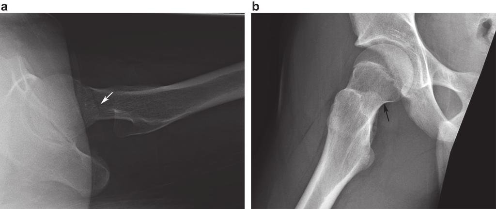32 C. Vuillermin and S.D. Bixby Fig. 2.5 (a) Cross-table lateral radiograph of the left femur in a 15-year-old female s/p fall demonstrates a fracture through the femoral neck (white arrow).
