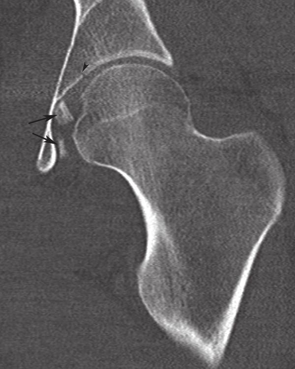 arrow), which represented an avulsed fragment from the femoral head (Pipkin type 1 fracture) dislocations of adjacent joints, ligamentous and meniscal injuries of the knee [16], as well as proximal