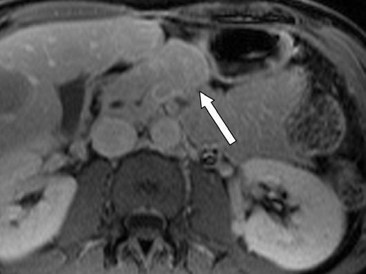 pancreas due to excellent soft-tissue contrast resolution of MRI. Lesion appearance is nonspecific and can be seen with adenocarcinoma as well.
