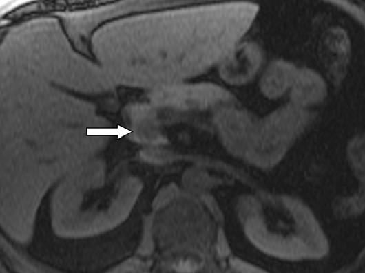 , xial venous phase gadolinium-enhanced T1-weighted fat-suppressed spoiled gradient-echo MR image shows lesion (arrow) is essentially isointense to surrounding pancreas, emphasizing