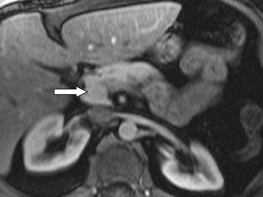 MRI of Islet ell Tumors of the Pancreas Downloaded from www.ajronline.org by 37.44.203.29 on 02/19/18 from IP address 37.44.203.29. opyright RRS.