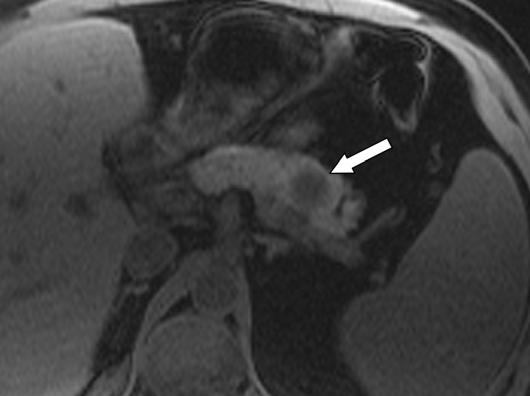 , xial arterial phase gadolinium-enhanced T1-weighted fat-suppressed spoiled gradient-echo MR image shows lesion (arrow) is now