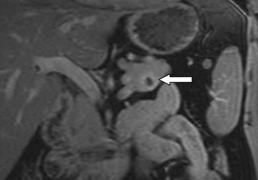 5 57-year-old man with history of gallstone pancreatitis and cystic lesion of pancreas thought to represent pseudocyst or cystic