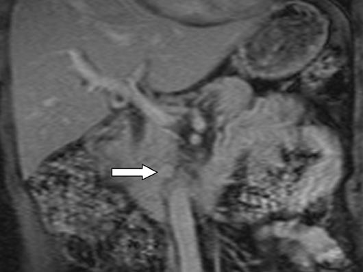 oronal gadolinium-enhanced T1-weighted fat-suppressed spoiled gradient-echo MR image shows irregular enhancement of mass (arrows) in pancreatic tail. Fig.