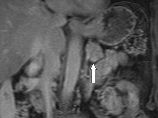 , oronal venous phase gadolinium-enhanced T1-weighted fat-suppressed spoiled gradient-echo MR image shows small (< 1 cm) hyperenhancing lesion (arrow) in pancreatic head.