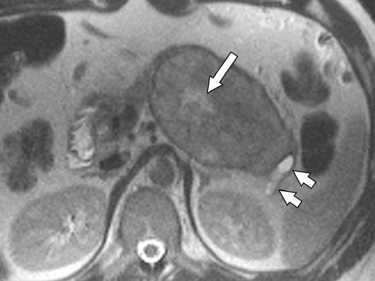 MRI of Islet ell Tumors of the Pancreas Downloaded from www.ajronline.org by 37.44.203.29 on 02/19/18 from IP address 37.44.203.29. opyright RRS. For personal use only; all rights reserved Fig.