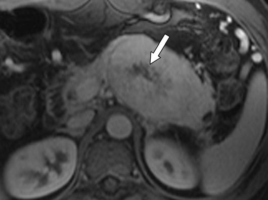 enter of lesion is high signal intensity due to necrosis (long arrow). Note dilatation of distal pancreatic duct (short arrows) with atrophy of this portion of gland.
