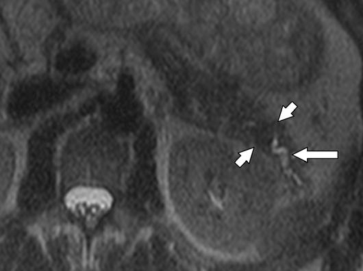 , oronal MR cholangiopancreatography image shows dilatation of pancreatic duct (arrow) in tail with normal-caliber pancreatic duct in remainder of gland (chevrons).