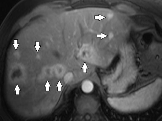 rim of enhancement with signal intensity different from the adjacent gland may help characterize the cystic lesion as an islet cell tumor (Fig. 10). Fig.