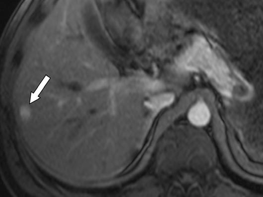 , xial arterial phase gadolinium-enhanced T1-weighted fat-suppressed spoiled gradient-echo MR image shows intense enhancement of multiple porta hepatis lymph nodes (chevrons) and multiple enhancing