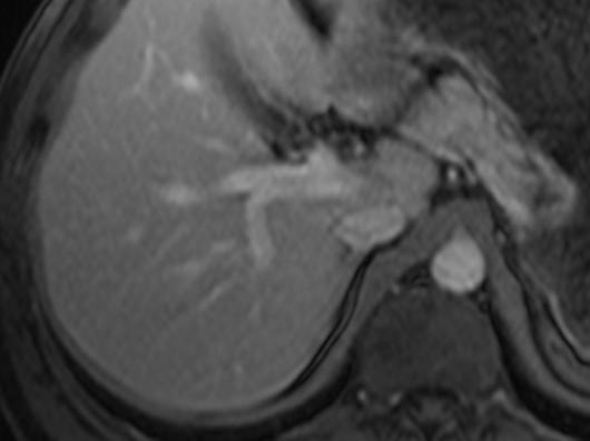, xial T1-weighted fat-suppressed spoiled gradient-echo MR image at slightly more cephalad level than shows multiple ring-enhancing hepatic metastases and smaller, homogeneously enhancing lesions