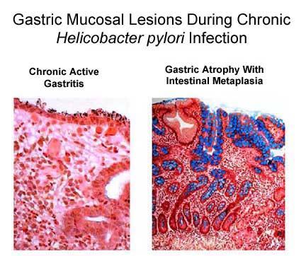 Hystologic examination: the optimal biopsy site During chronic H. pylori infection, atrophic gastritis (AG) and intestinal metaplasia (IM) begin in the antrum, where H.
