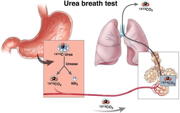 Non Invasive Diagnosis Urea breath test (UBT): principle UBT takes advantage of the strong urease activity expressed by H.