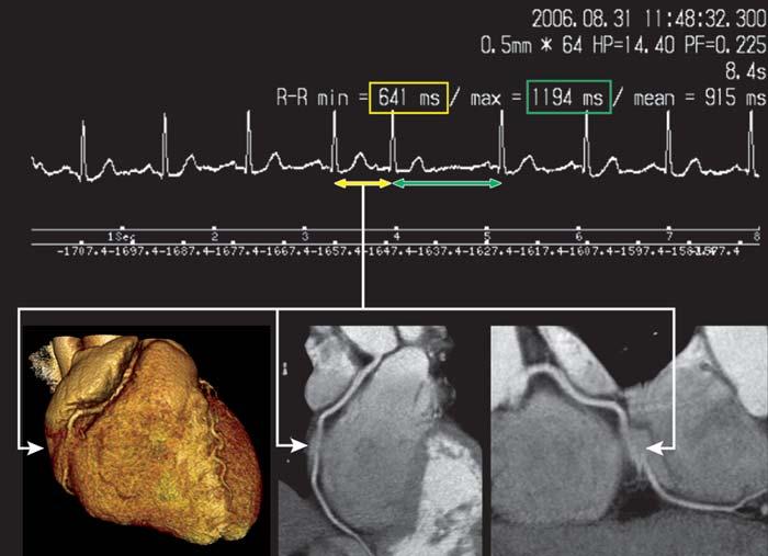 rtifacts in EG-Synchronized MDT oronary ngiography Fig. 3 54-year-old woman with suspected coronary artery disease. Image shows blurring due to motion caused by premature atrial contraction.