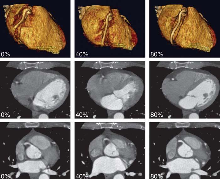 This segment of right coronary artery is frequently affected by motion artifacts. Mean heart rate was 66 beats per minute. R-R interval during acquisition varied between 641 and 1,194 milliseconds.