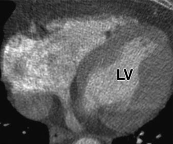 Patient performed Valsalva maneuver during image acquisition that is recognized by contrast column with convex shape toward superior vena cava (SV on coronal image, D), whereas saline flush should be