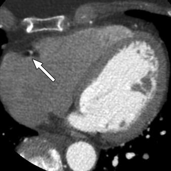 During spiral acquisition, position registered by each view shifts. D, Miscalculation may cause hypodense artifacts (arrows) that rotate around high-density contrast-filled coronary artery.