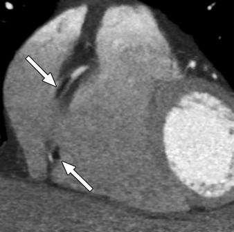 rtifacts on the right coronary artery due to high contrast density in the right atrium can be effectively reduced using a saline flush.