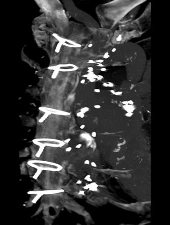 Severe high-density surgical clip artifacts hamper arterial lumen evaluation at course of left internal mammary artery, which was used for bypassing left anterior descending coronary artery (D).