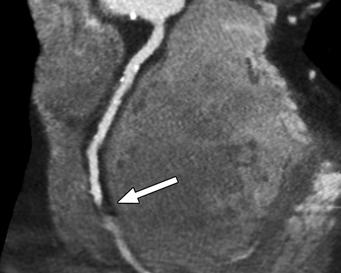 (R) at crux where it diverges into R continuation in atrioventricular groove and in posterior descending branch