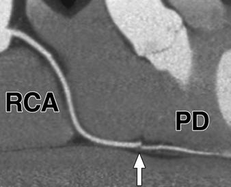 D, urved multiplanar reconstruction of right coronary artery in two perpendicular longitudinal directions.
