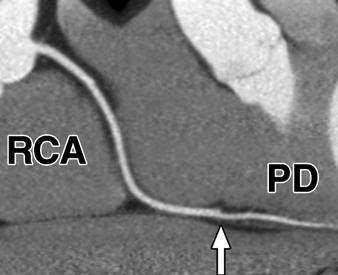 sharply delineated in proximal part but appears interrupted halfway (arrow), whereas further coronary artery