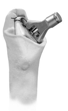 If the bone stock is inadequate at the greater trochanter, use an alternative reference point such as the level of the osteotomy cut, the medial calcar, or the lesser trochanter.