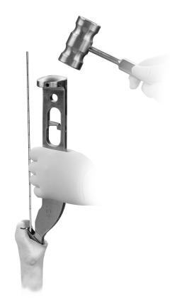 Attach the starter Tamp Assembly to the Rasp Handle (Fig. 13a). Do not use the MIS CPT Rasp Handle (8334-81) with any impaction grafting instruments.