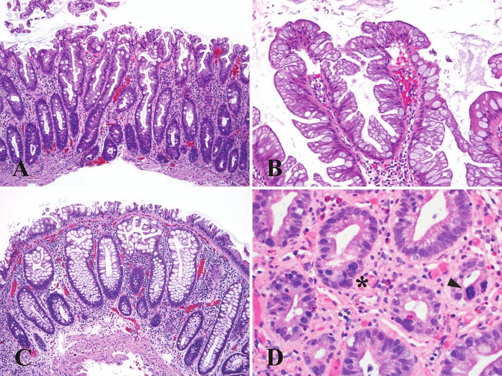 Figure 1. Hyperplastic polyp. A, Typical appearance with crypt dilation and serrations limited to the upper portion, and crypt bases that are dark and narrow.