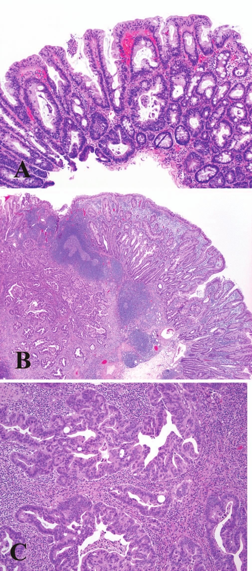 Figure 3. A, A sessile serrated adenoma/polyp (SSA/P) with cytologic dysplasia; some of the dysplastic crypts have serrations. B, Invasive adenocarcinoma arising in an SSA/P with cytologic dysplasia.