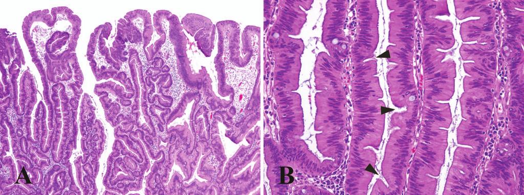 Figure 4. A, Traditional serrated adenoma with an exophytic, coarsely villiform growth pattern. B, Higher-power view showing ectopic crypt formation (arrowheads).
