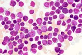 Conventional diagnosis in acute leukemias Cytology: