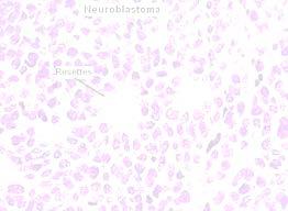 Neuroblastoma these