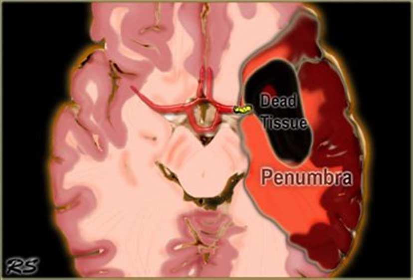 Ischemic penumbra Severity of ischemic stroke depends on: degree of impairment of cerebral blood flow and the time to reperfusion.