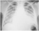 Acute Chest Syndrome Defined as a new infiltrate in a patient with sickle cell disease May