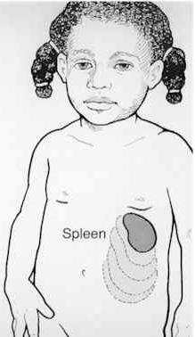 Splenic Sequestration Collection of sickled RBCs in splenic sinusoids Often quite acute; minor episodes also occur Precipitating events unclear Peak age 6