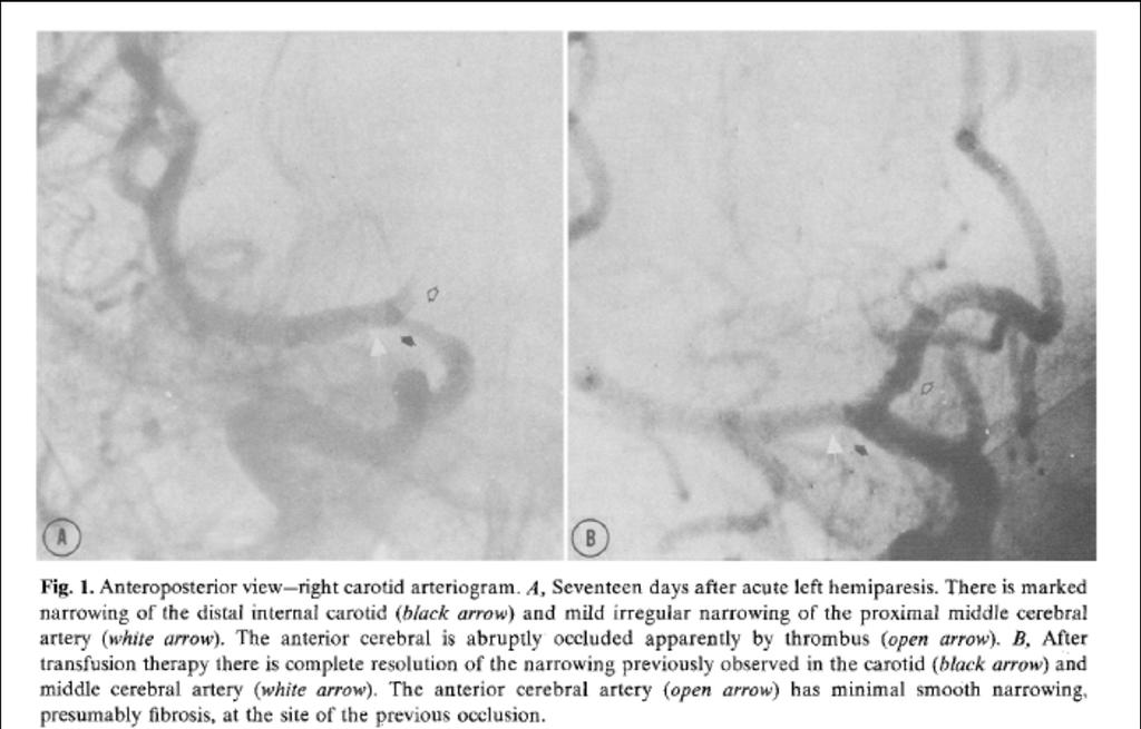 Treatment of Acute Ischemic Events Case reports of
