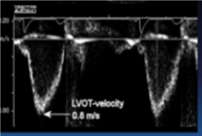 LVOT Velocity Measurement Apical 5 chamber or ApLAX Small sample volume With PW, start apically & advance > LVOT until welldefined
