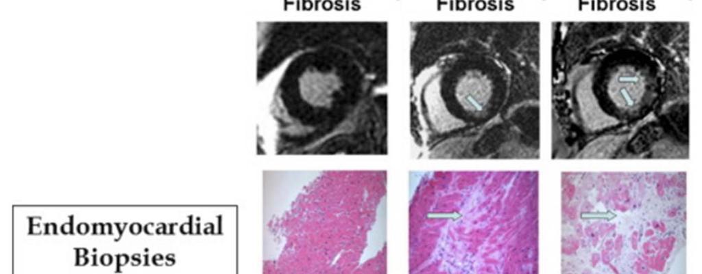 Fibrosis by CMR