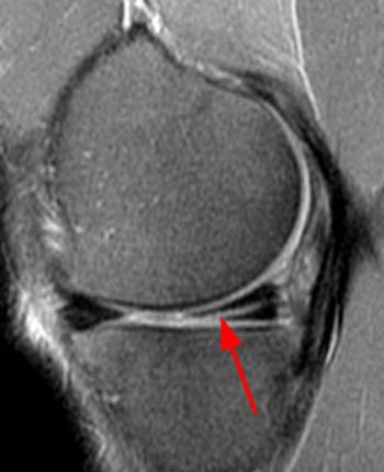 MRI of a medial meniscus tear Acute traumatic tears occur most frequently as a result of a twisting injury to the knee when the foot is planted.