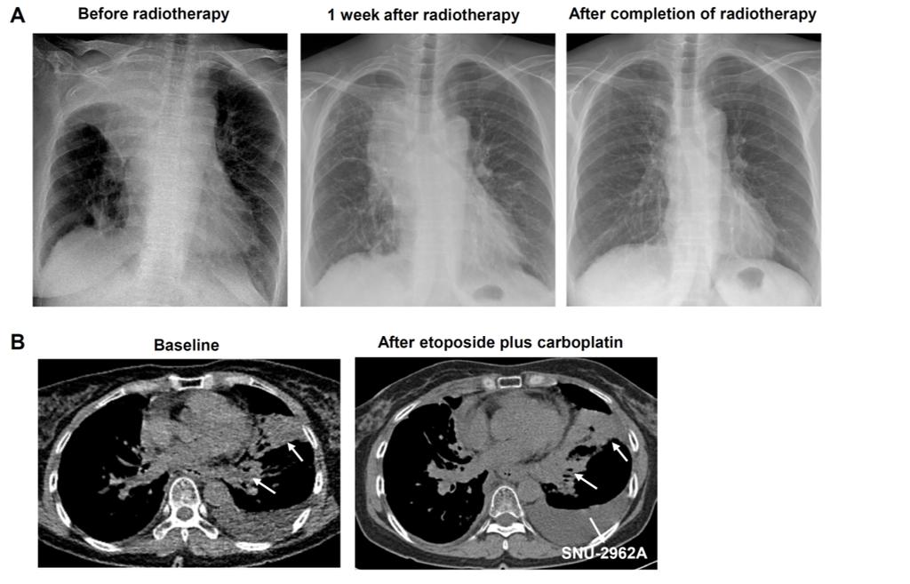 Supplementary Figure S11. Images of the chest showed dramatic response to salvage radiotherapy (A), but refractory disease after one cycle of etoposide and carboplatin (B).